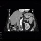 Metastasis of renal cell carcinoma in pancreas and adrenal gland, nephrectomy: CT - Computed tomography